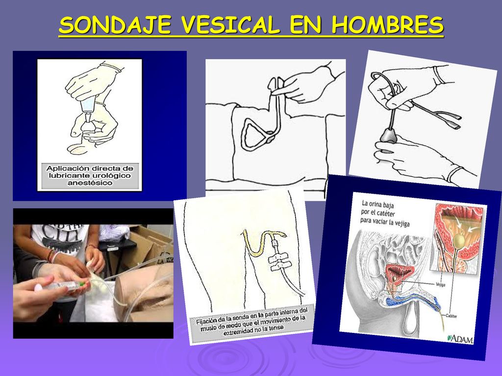 colocacion de sonda foley en hombres